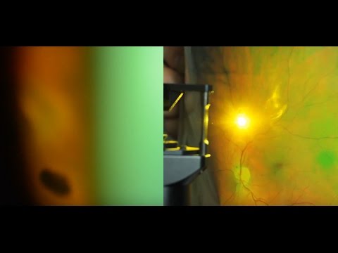 Видео: Укрепление сетчатки лазером. Лечение сетчатки глаза