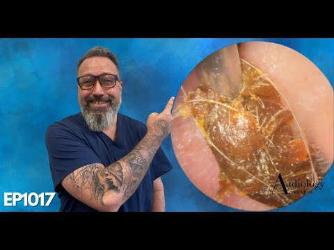 Видео: Длинные ушные серные пробки, глубокое удаление ушной серы и кожи - EP1017