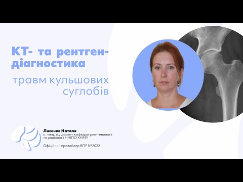 Видео: КТ  та рентген діагностика травм кульшових суглобів  