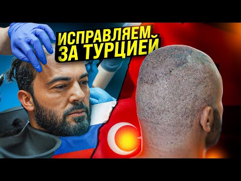 Видео: ПЕРЕСАДКА ВОЛОС ОЛИМПИЙСКОМУ ЧЕМПИОНУ ПОСЛЕ ТУРЦИИ