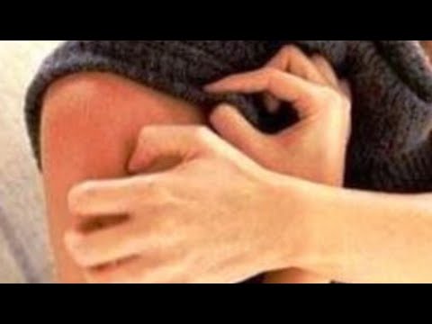 Видео: Снимаем порчу "Почесуху".