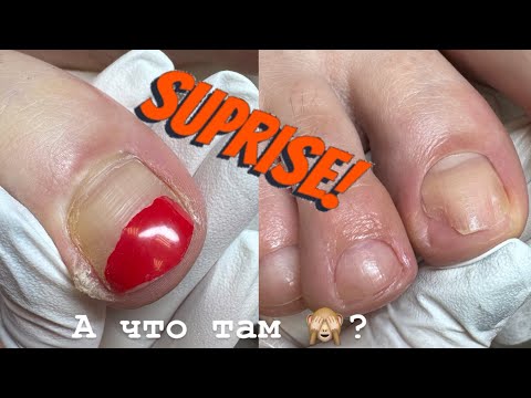 Видео: ЧТО ПОД ПОКРЫТИЕМ ? /Педикюр / Онихолизис / Отслоение ногтя / Что мы сделали ? #педикюр #онихолизис