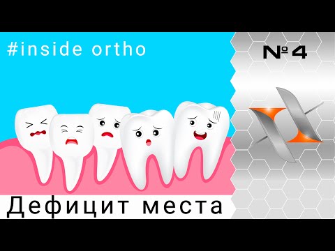 Видео: Почему зубам не хватает места? Дефицит места в зубном ряду (мини-семинар, ортодонтия)