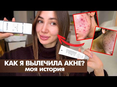Видео: КАК я ВЫЛЕЧИЛА АКНЕ? средства, процедуры