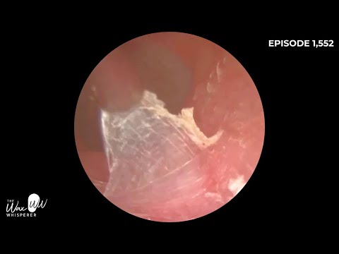 Видео: 1552 – Извлеченная из уха омертвевшая кожа, обнажающая язвенную и грануляционную ткань