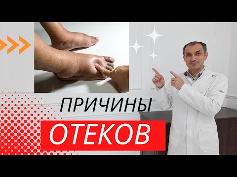 Видео: Отличие венозных отеков от других видов отеков. Флеболог Москва.