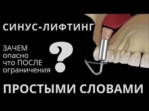 Видео: Синус лифтинг. Открытый и закрытый. После синус лифтинга