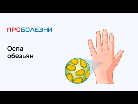 Видео: Оспа обезьян