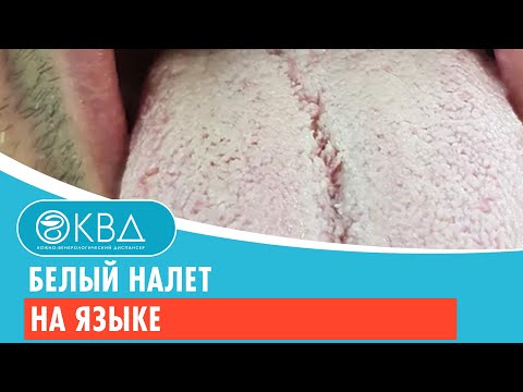 Видео: 👅 Белый налет на языке. Клинический случай №386