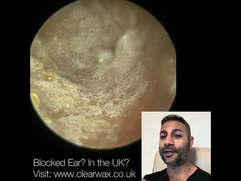 Видео: 1632 - Удаление омертвевшей кожи, пораженной хроническим грибком, у 98-летнего пациента с помощью...