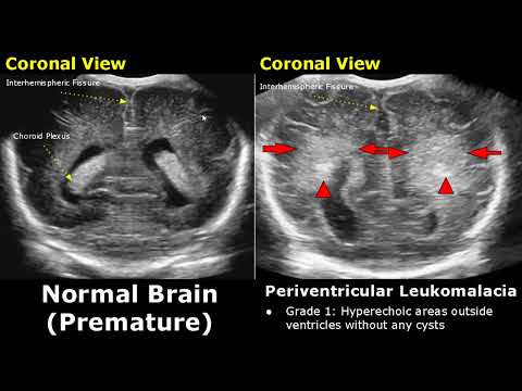 Видео: УЗИ головного мозга новорождённых: нормальные и патологические изображения | УЗИ головы доношенны...