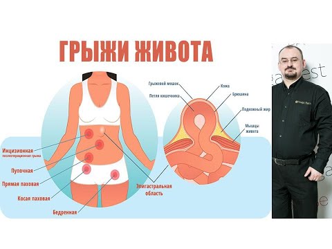 Видео: Грыжи живота