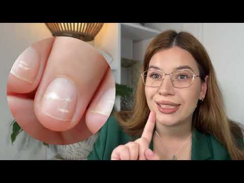 Видео: ВІДШАРУВАННЯ ТА БІЛІ ПЛЯМИ НА НІГТЯХ / Причини, що робити