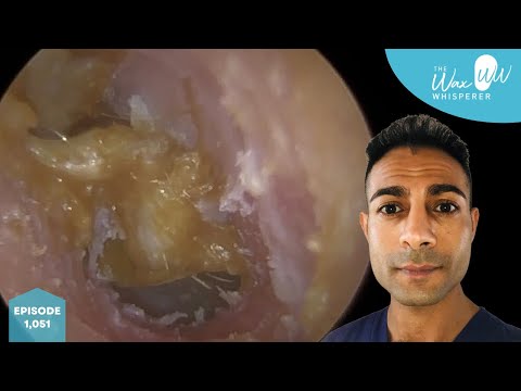 Видео: 1051 - Удаление воспаленных и инфицированных ушных серных пробок и отшелушивание омертвевшей кожи