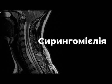 Видео: Сирингомієлія