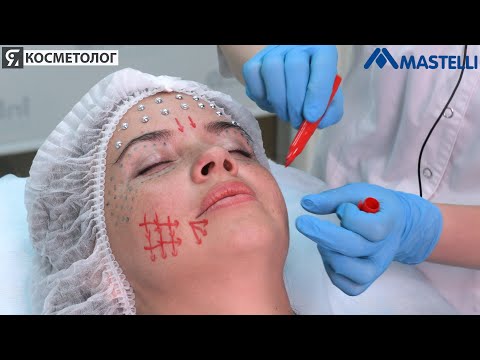 Видео: Разметка лица и других зон для инициирования полинуклеотидами