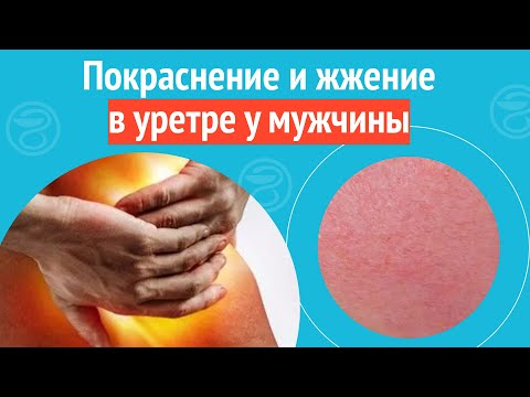 Видео: 😡 Покраснение и жжение в уретре у мужчины. Клинический случай №1220