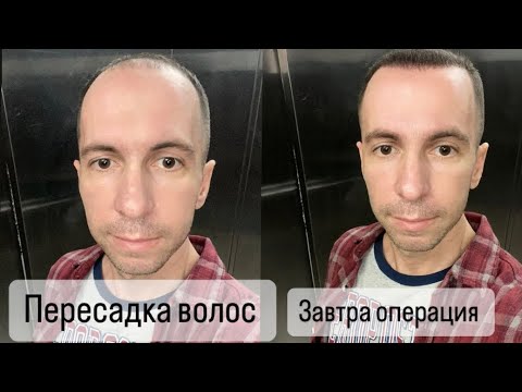 Видео: Eugene Reboot ✨ Пересадка Волос. Завтра всё изменится. 