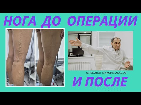 Видео: ЭВЛК, КЛАКС, Склеротерапия вен на ногах. Флеболог Москва.