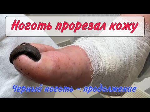 Видео: Страшный ноготь/ ноготь врезался в кожу/старческие ногти