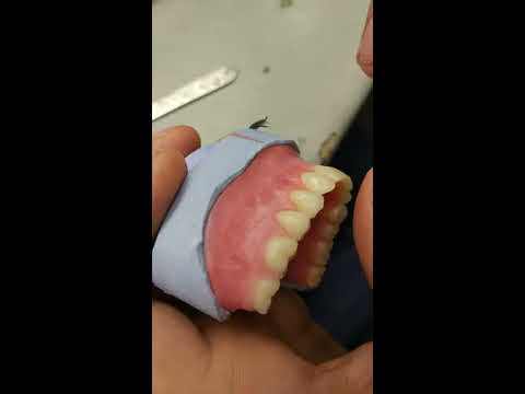 Видео: Моделирование искусственной десны на съемных протезах