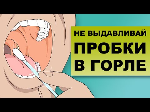 Видео: ПОЧЕМУ ОПАСНО ВЫДАВЛИВАТЬ ПРОБКИ