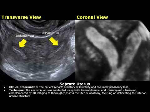 Видео: Заключение по УЗИ врожденных аномалий матки | УЗИ двурогой, двурогой и однорогой матки