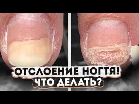 Видео: ЧТО ДЕЛАТЬ ПРИ ОНИХОЛИЗИСЕ И КАК ИЗБАВИТЬСЯ ОТ ЭТОЙ ПРОБЛЕМЫ?