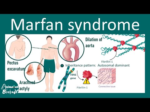 Видео: Синдром Марфана | Патофизиология, диагностика, лечение | USMLE STEP1