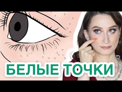 Видео: Милиумы - это болезнь❓ИЗБАВЛЯЕМСЯ НАВСЕГДА❗️