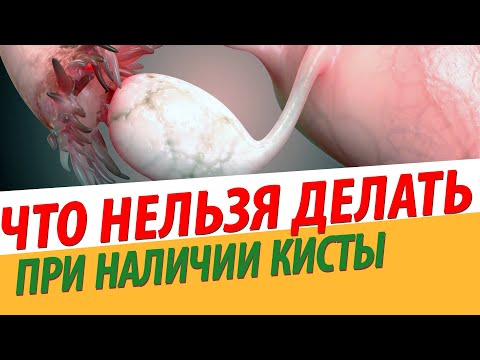 Видео: ЧТО НЕЛЬЗЯ ДЕЛАТЬ , имея кисту яичника❓❓❓