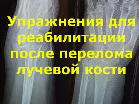 Видео: Упражнения для реабилитации после перелома лучевой кости. Вторая версия.