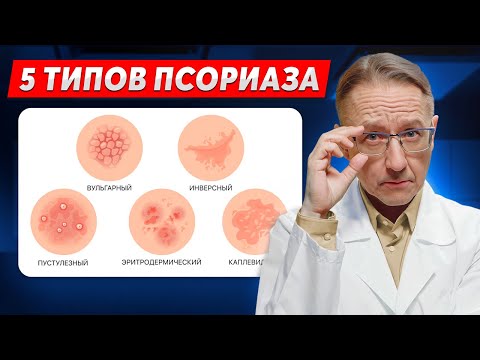 Видео: Какой у вас тип псориаза? Определить и вылечить, 10 Видов псориаза!