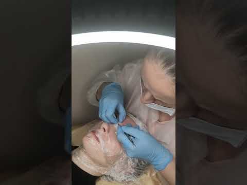 Видео: клиентка молодая девушка на  механической чистке)#механическаячистка #аппаратнаякосметология