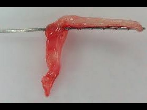 Видео: Как удалять пульпу из каналов?