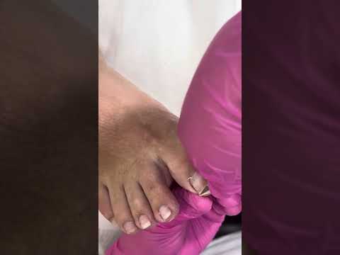 Видео: Обработка вросшего ногтя  #вросшийноготь #подолог #подология #тампонада  #фруктовыйпедикюр 