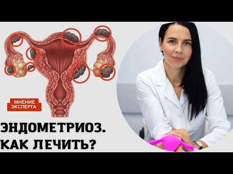 Видео: КАК ЛЕЧИТЬ ЭНДОМЕТРИОЗ?