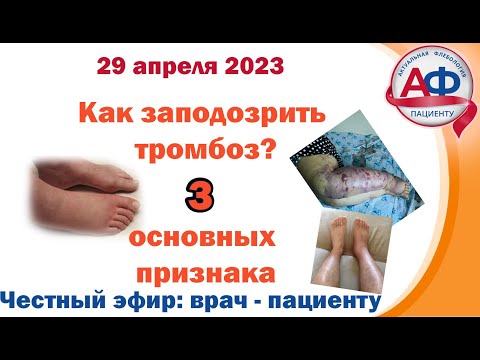 Видео: Как заподозрить тромбоз: 3 основных признака!