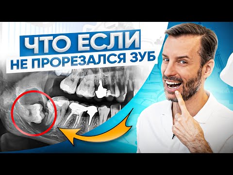 Видео: Зуб застрял в кости, что делать? Ретинированный зуб