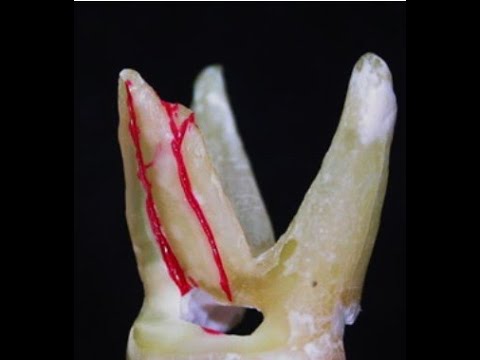 Видео: Одонтогенный гайморит как истинная эндо-патология. Удаление "кисты" зуба. Периодонтит Гранулема зуба