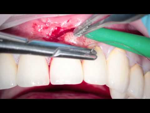 Видео: Закрытие рецессии после протезирования