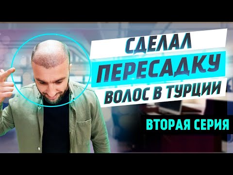 Видео: Пересадил волосы в Турции за 1000 $ | Облысение | Серия 2