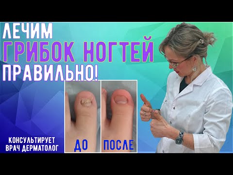 Видео: Правильное лечение грибка ногтей, онихомикоза