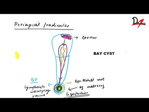 Видео: Радикулярная киста: патогенез, муковисцидоз, радиочастотная ангиопатия и лечение