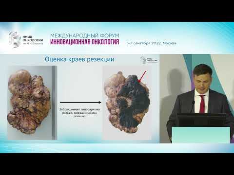 Видео: Забрюшинные саркомы: современная концепция диагностики и лечения. Стилиди И.С.