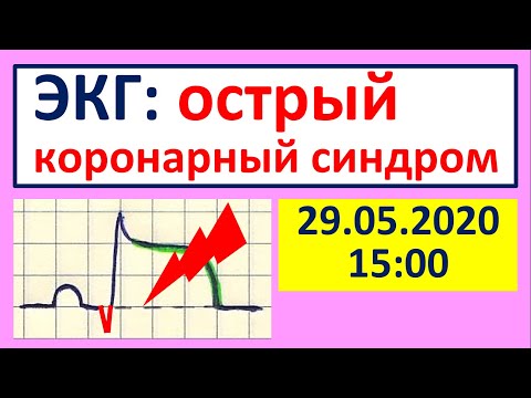 Видео: Важнейшие ЭКГ-синдромы: острый коронарный синдром