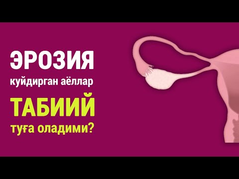 Видео: Эрозия куйдирган аёллар табиий туға оладими?