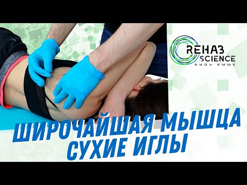 Видео: Постановка сусхих игл в позиции на боку. Широчайшая мышца