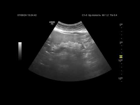 Видео: УЗИ. Доктор Иогансен. Видеопримеры. Выпуск 82. Липоматоз поджелудочной железы.