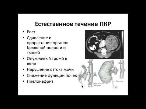 Видео: Опухоли почек и мочевого пузыря.